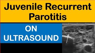 Juvenile Recurrent Parotitis On Ultrasound [upl. by Anitnemelc]