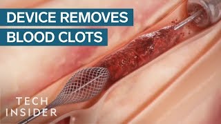 How This Device Safely Removes Blood Clots  Tech Insider [upl. by Leibarg551]