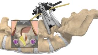 MAS® TLIF Patient Animation [upl. by Breed]