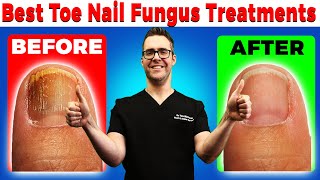 Best Toe Nail Fungus Treatments Onychomycosis Remedies [upl. by Peck411]