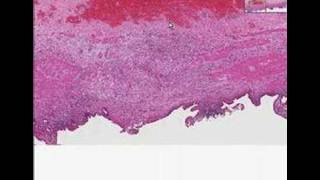 Histopathology GallbladderChronic cholecystitis [upl. by Lyndell]