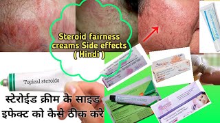 Harmful steroid  fairness cream  how to reduce side effects why you should avoid steroid creams [upl. by Asiulairam]