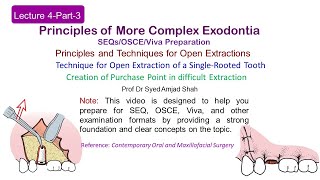 Lecture 4 Part3 SEQs  Open Extraction of Single Rooted Tooth  OSCE  VIVA [upl. by Jacinta228]