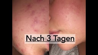 Pickel amp Akne bekämpfen  Gesichtspflege Routine  BEAUTYSALAD [upl. by Asselim947]