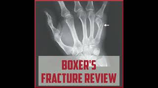 Boxer’s Fracture Treatment  Symptoms and Causes  Diagnosis  Prevention health [upl. by Nahsab]