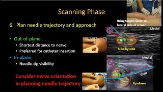 USguided Popliteal Sciatic Nerve Block [upl. by Nilerual442]