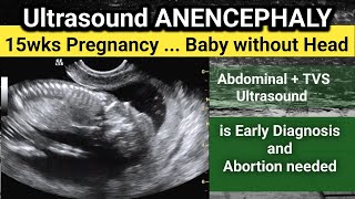 ANENCEPHALY  15 wks Pregnancy Ultrasound  why early Diagnosis is important [upl. by Ranilopa]