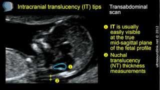 Intracranial translucency IT tips and tricks [upl. by Bathelda]