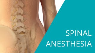 Spinal Anesthesia  The steps of spinal anesthesia [upl. by Adihsaar]