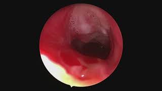 Subglottic stenosis  from injury to repair [upl. by Wojcik542]