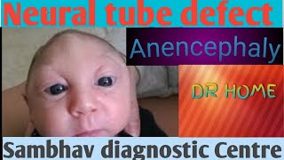 Anencephaly Neural tube defect Drshikha Agarwal Drhomeclass 12 biology [upl. by Yancey]