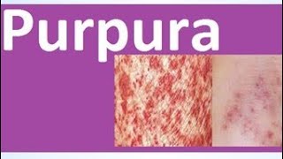 Purpura disorder of blood vessels [upl. by Nelyaw]