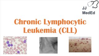 Chronic Lymphocytic Leukemia CLL Symptoms ex Skin Blisters Diagnosis and Treatment Vit D [upl. by Lepper]