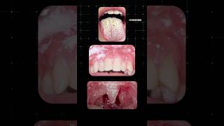 வாயில் ஏற்படும் பூஞ்சை தொற்று Oral Thrush Dr Isacc Abbas [upl. by Careaga]