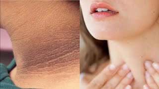 Dark Neck Home Remedy  Whitening DIY  sun tan  ummilife diy skincare [upl. by Llenrahc753]