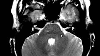 Distended perivascular spaces in the pons [upl. by Ajet]