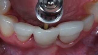 Implant supported provisional [upl. by Osmond]