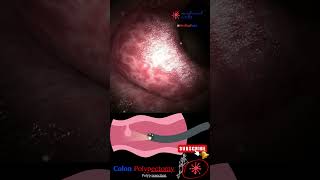 Coloscopy  Colon Polyp Resection  Polypectomy [upl. by Aynekal]