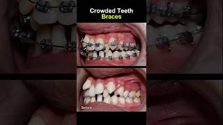 Teeth very crowded and crooked before braces orthodontist braces dentist [upl. by Eniruam]