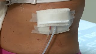 How to care for a postsurgery wound drainage system and gauze dressing [upl. by Sherry286]