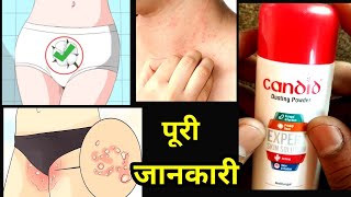 Candid Powder uses and side effects in Hindi  Candid Dusting Powder  mycoderm powder  Clotrimazol [upl. by Menis784]