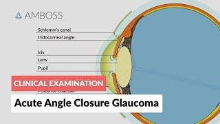 Acute Angle Closure Glaucoma [upl. by Nomrah]