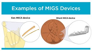 Innovations in Glaucoma Treatment MIGS [upl. by Ahsed406]