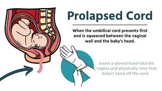 Pregnancy amp Delivery Emergencies in EMS [upl. by Yrtua]