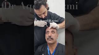 Forehead wrinkles filler  Forehead static wrinkles foreheadlines draqeel skintreatment fillers [upl. by Sup]