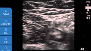 Ultrasoundguided Saphenous Nerve Block [upl. by Llebanna]