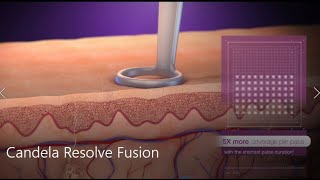 Acne Scar and Wrinkle Treatment by Candela 3D medical animation [upl. by Atworth]