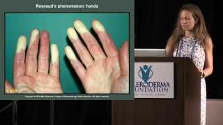 2015 Nashville Scleroderma Mini Medical School Dr Jessica Gordon [upl. by Wester]