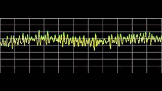 Hemangioma  Rife Frequencies [upl. by Lamdin]