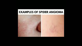 Spider Angioma [upl. by Nimad]