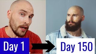 5 MONTH MINOXIDIL BEARD TRANSFORMATION [upl. by Eizzil924]