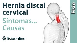 ¿Qué es la hernia discal cervical y cuáles son sus causas y síntomas [upl. by Yun371]