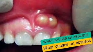 What causes an abscess [upl. by Rabma]