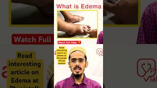 Edema क्या होता है  इसके Types क्या होते है  edema swelling shortsfeed [upl. by Aicatsanna]