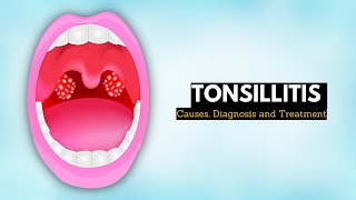 Tonsillitis Causes Signs and Symptoms Diagnosis and Treatment [upl. by Caves]