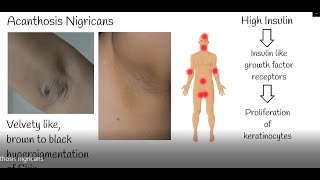 Acanthosis nigricans  Velvet skin discoloration Causes and Treatment of acanthosis Nigricans [upl. by Zennie]