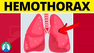 Hemothorax Medical Definition  Quick Explainer Video [upl. by Aleicarg652]