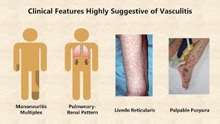 Vasculitis  An Overview [upl. by Cassi]