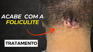 MELHORES PRODUTOS para tratar a FOLICULITE de FORMA SEGURA [upl. by Dickman]