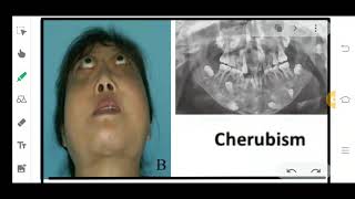 CHERUBISM  FIBRO OSSEOUS LESION OF ORAL CAVITY  BONE DEFECT [upl. by Ycrad]