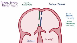 Atrial septal defect ASD repair causes types symptoms amp pathology [upl. by Nievelt551]