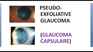 Ophthalmology Pseudo Exfoliative Glaucoma CAPSULARE PEX PEXG Target sign moth eaten Pilocarpine [upl. by Dombrowski781]