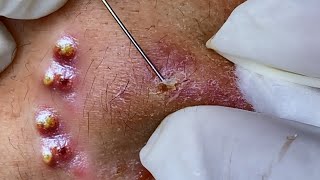 Big Cystic Acne Blackheads Extraction Blackheads amp Milia Whiteheads Removal Pimple Popping [upl. by Eillib]