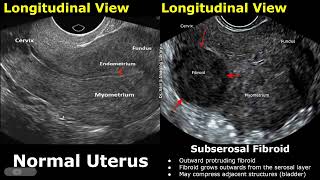 Uterus Ultrasound Normal Vs Subserosal Fibroid Images  Uterine Leiomyomas Cases  Pelvic USG Cases [upl. by Bord381]