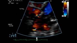 Atrial Septal Defect  Ostium Secundum Type  TTE [upl. by Lutero]