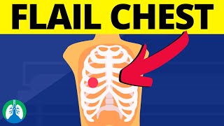 Flail Chest Medical Definition  Chest Trauma [upl. by Treble7]